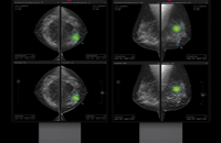 Lunit's Insight DBT gets certification from EU for medical device 