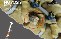 CGBio gets FDA approval for Novosis Putty