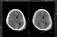 JLK gets OK from FDA for ICH diagnosis solution